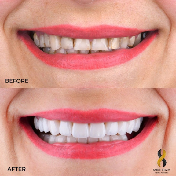 Upper Jaw Treatment Result