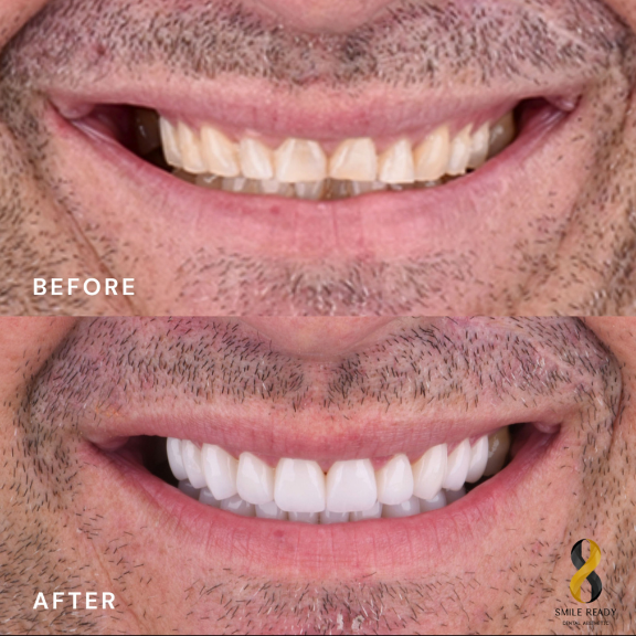 Full Mouth Treatment Result